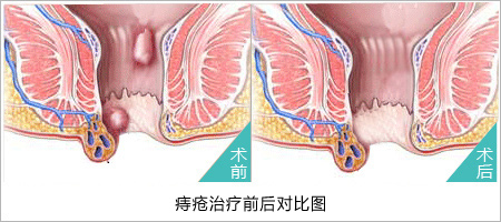 內(nèi)痔術(shù)前與術(shù)后對比圖